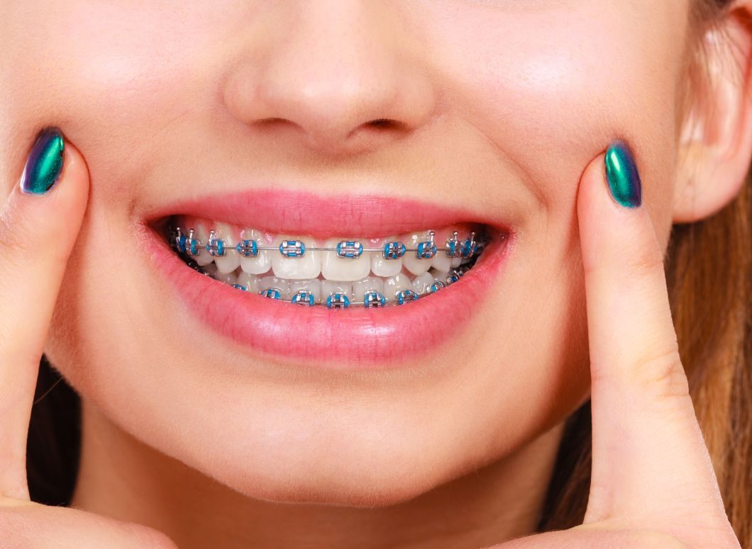 IMPLANTES Y DIENTES EN 24 HORAS (4)