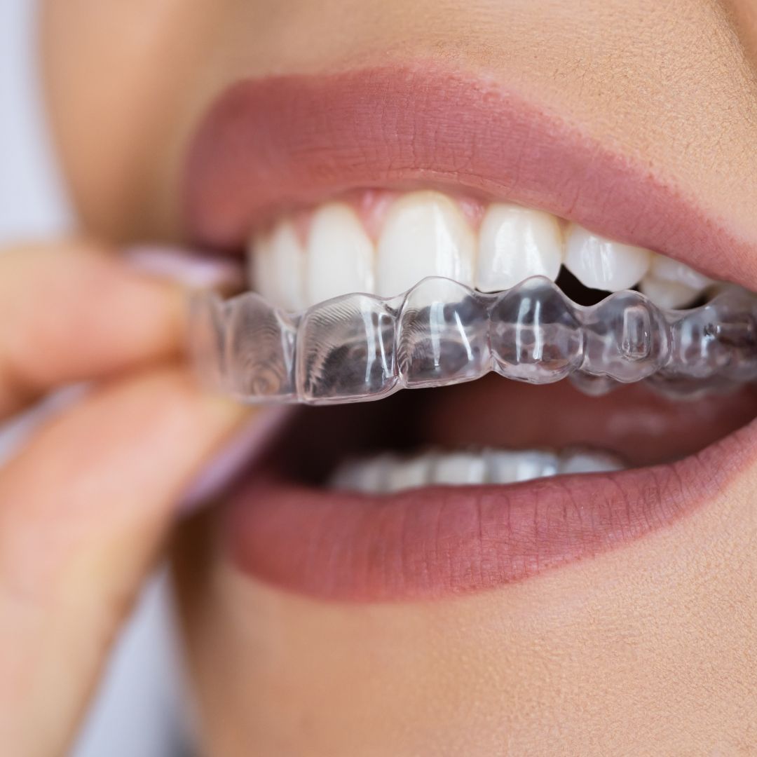 IMPLANTES Y DIENTES EN 24 HORAS (3)